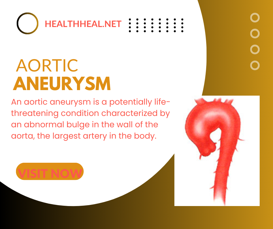 aortic aneurysm ,