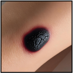 melanoma, skin cancer, spot skin cancer
